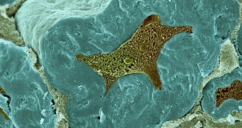 درمان جدید ام اس، فلج را معکوس می کند