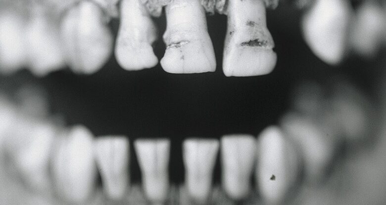 دندان ها پاتوژن ها را برای صدها سال حفظ می کنند