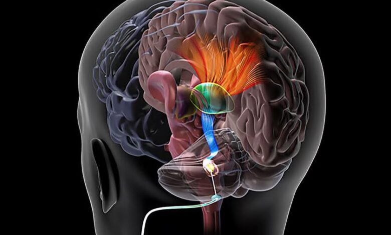 یافت روشی برای تحریک عمیق مغز پس از سکته